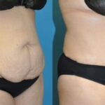 Tummy Tuck #54 - Before and After