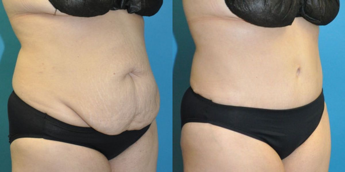 Tummy Tuck #54 - Before and After
