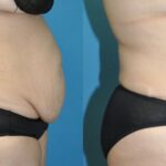 Tummy Tuck #54 - Before and After