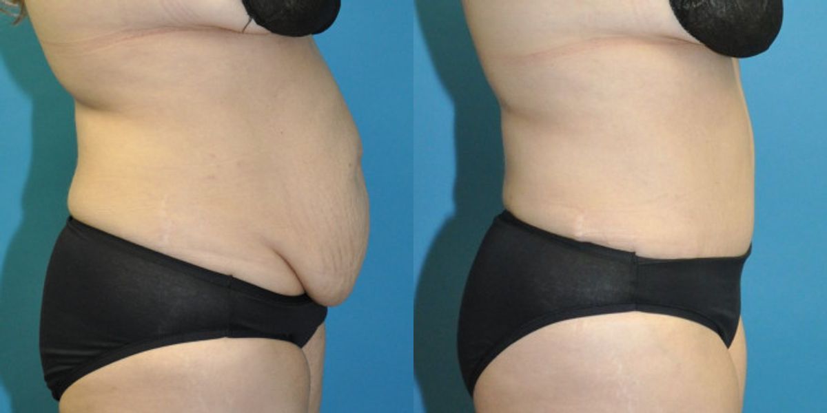 Tummy Tuck #54 - Before and After