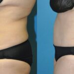 Tummy Tuck #54 - Before and After