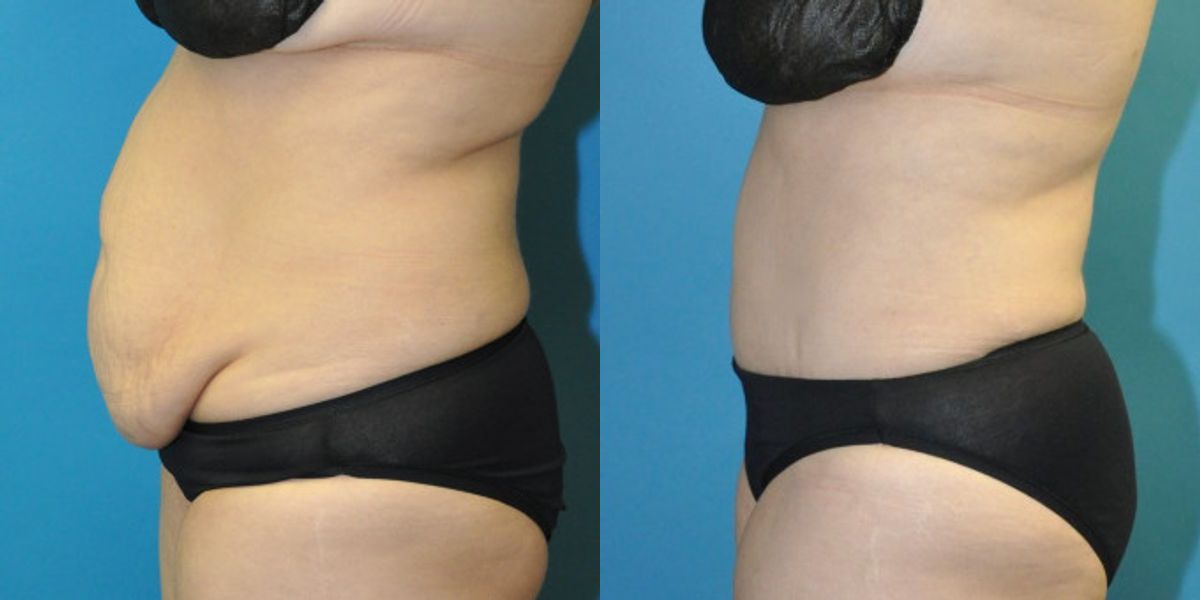 Tummy Tuck #54 - Before and After