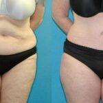 Tummy Tuck #55 - Before and After