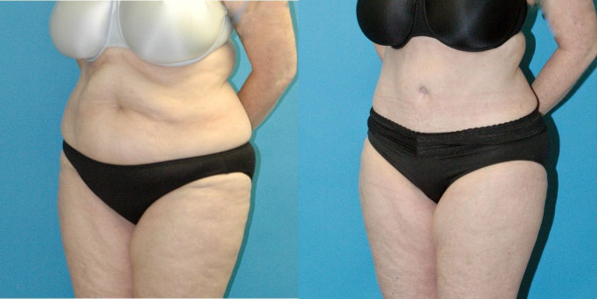 Tummy Tuck #55 - Before and After