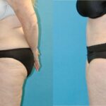 Tummy Tuck #55 - Before and After