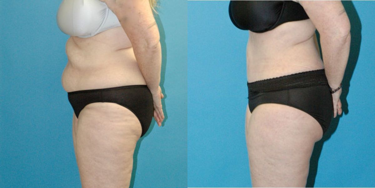 Tummy Tuck #55 - Before and After