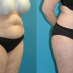Tummy Tuck #55 - Before and After