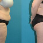 Tummy Tuck #55 - Before and After