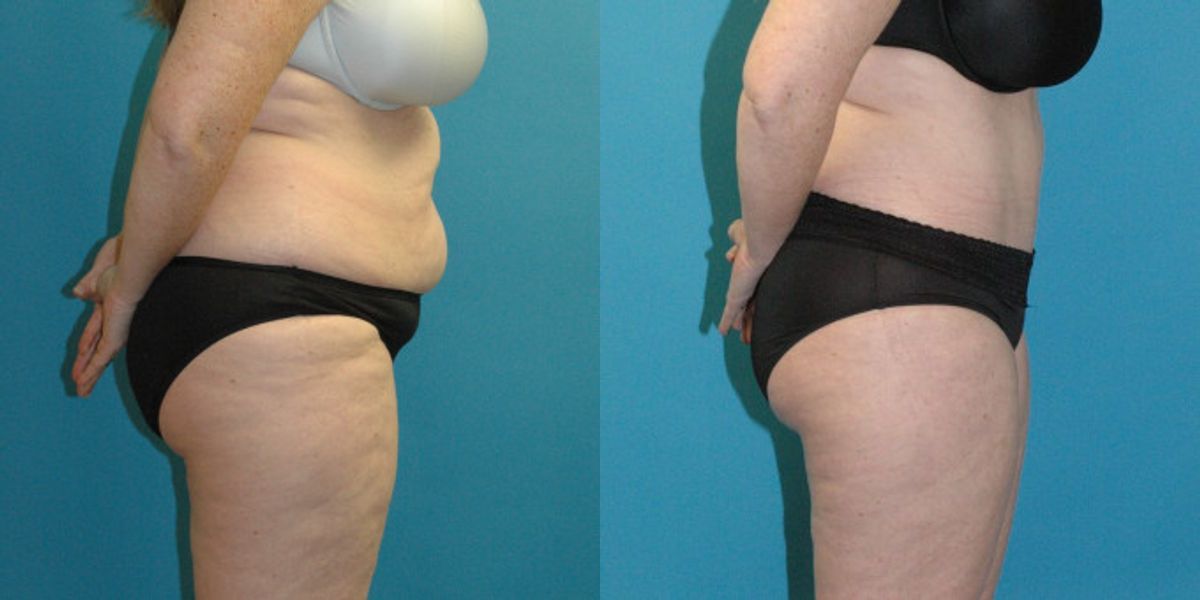 Tummy Tuck #55 - Before and After