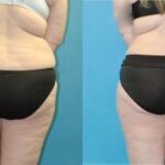 Tummy Tuck #55 - Before and After
