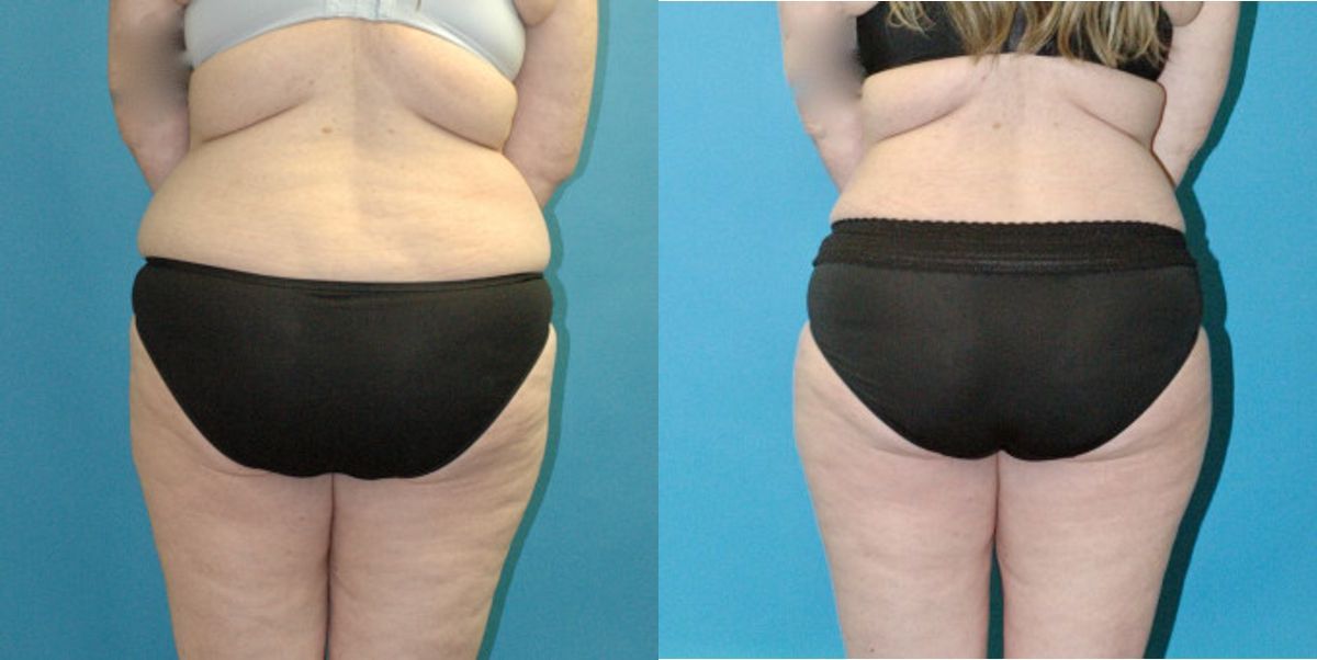 Tummy Tuck #55 - Before and After