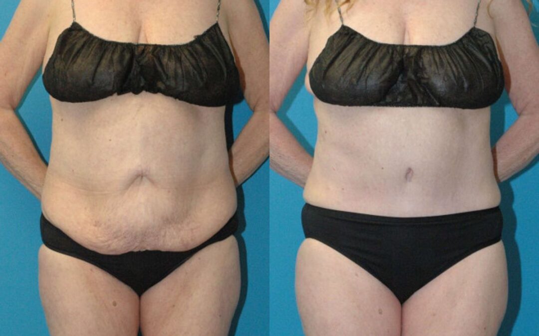 Tummy Tuck #56