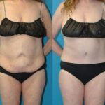 Tummy Tuck #56 - Before and After