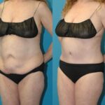 Tummy Tuck #56 - Before and After