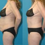 Tummy Tuck #56 - Before and After