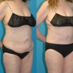 Tummy Tuck #56 - Before and After