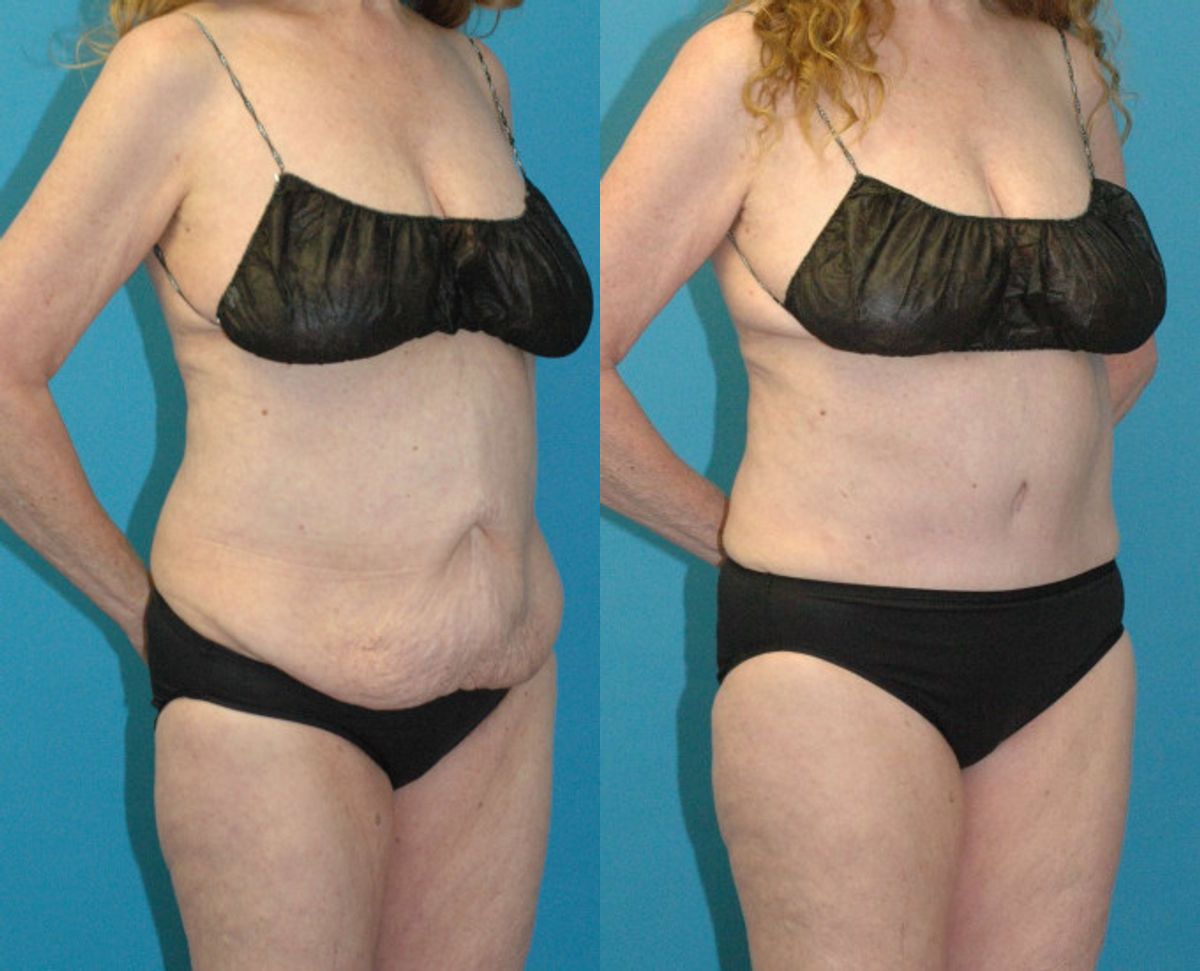 Tummy Tuck #56 - Before and After