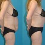 Tummy Tuck #56 - Before and After