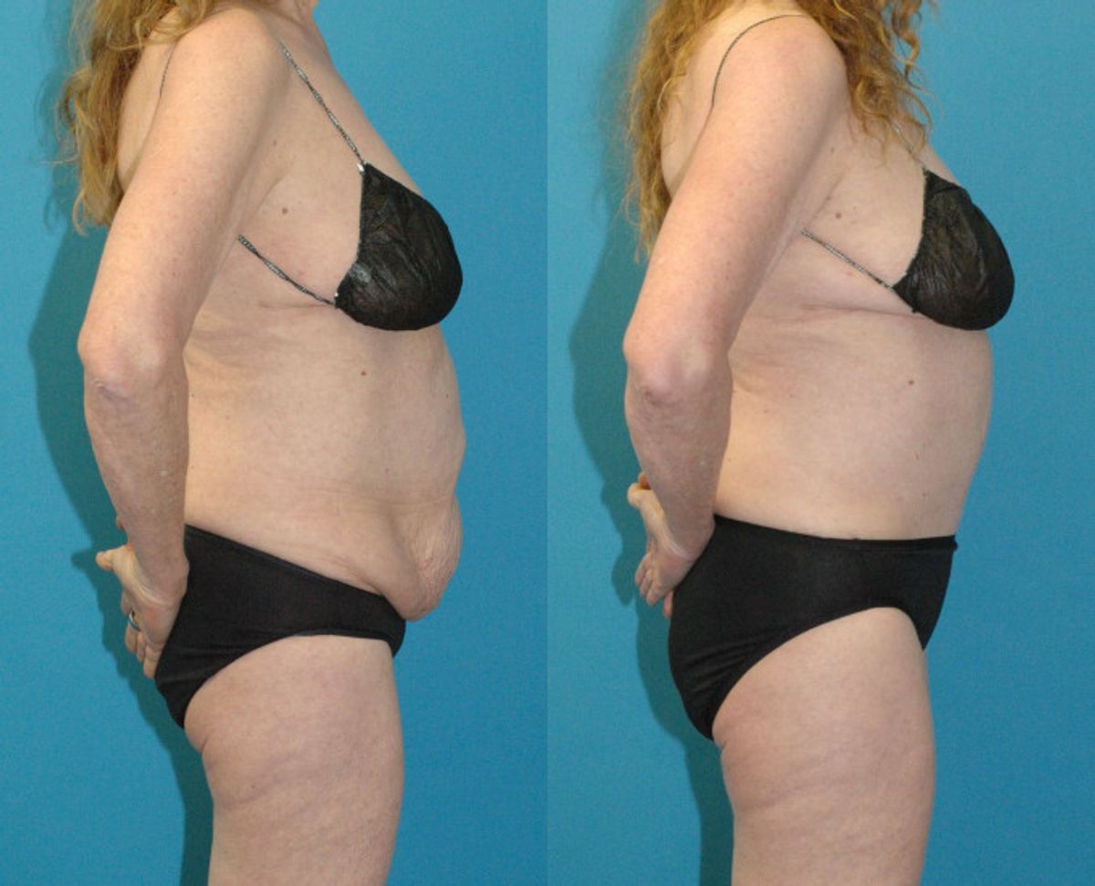 Tummy Tuck #56 - Before and After