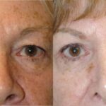 Upper and Lower Blepharoplasty - Before and After