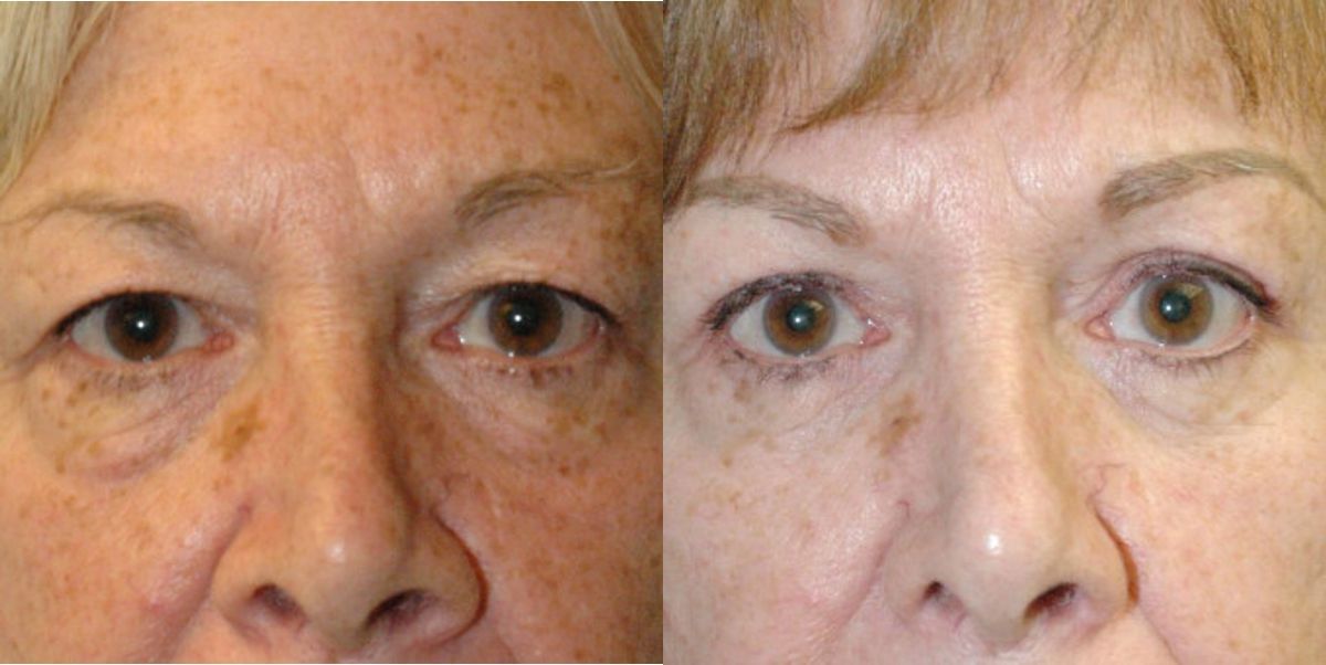 Upper and Lower Blepharoplasty - Before and After