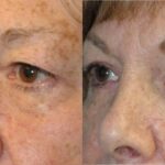 Upper and Lower Blepharoplasty - Before and After