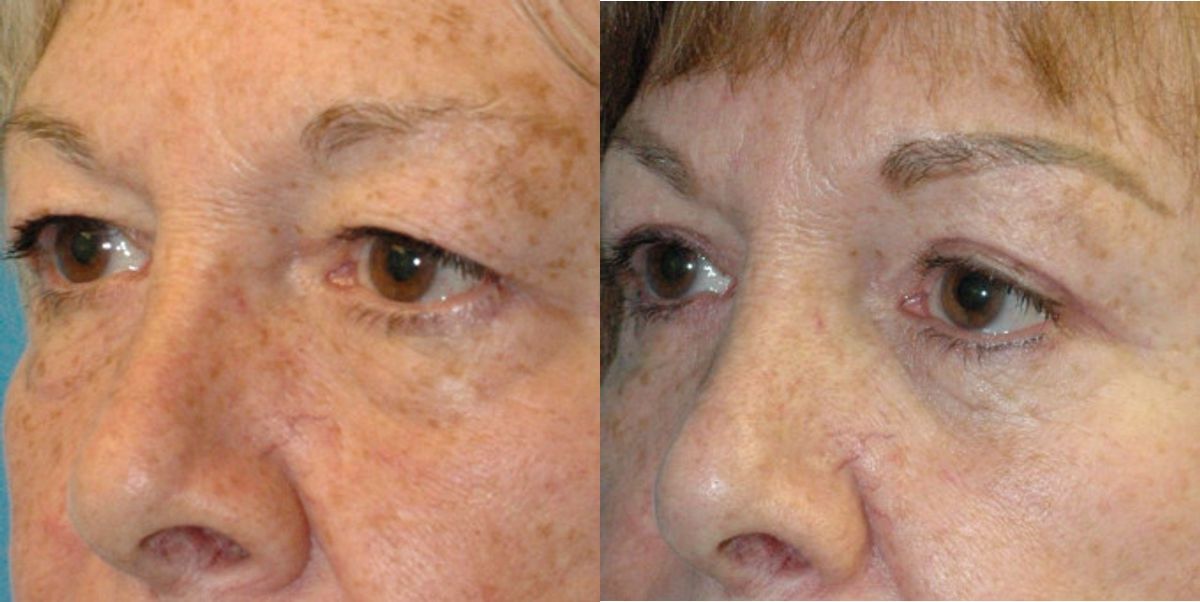 Upper and Lower Blepharoplasty - Before and After