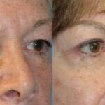 Upper and Lower Blepharoplasty - Before and After
