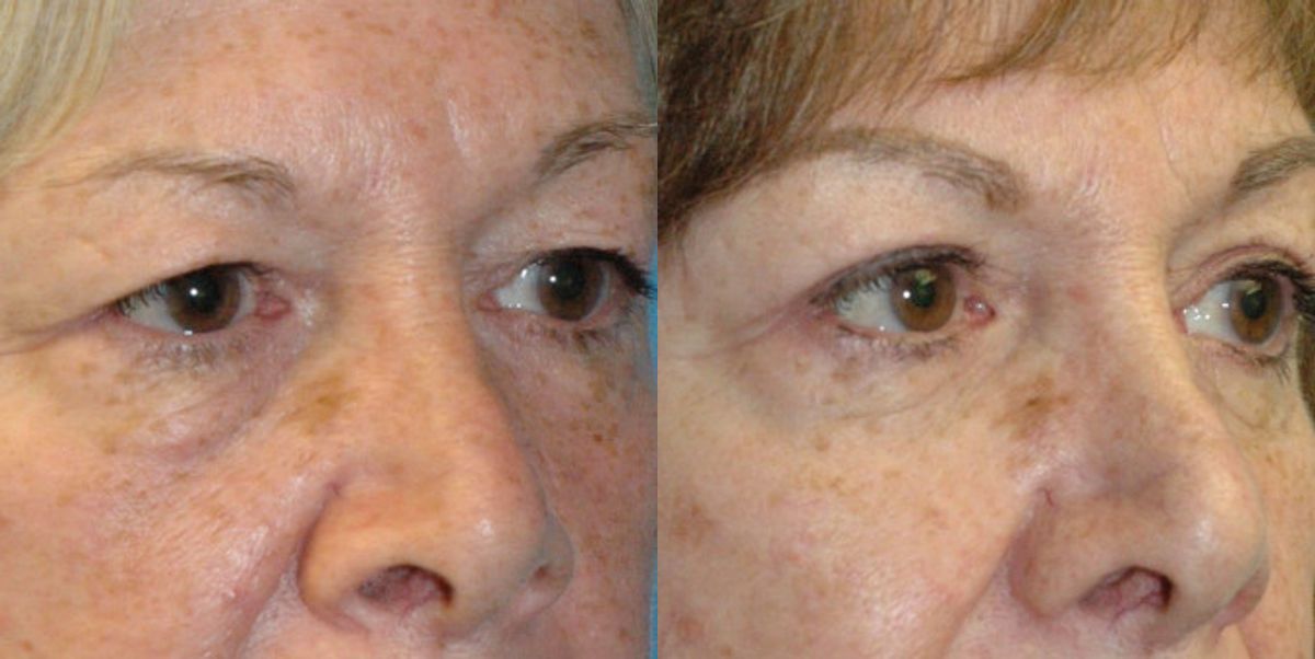 Upper and Lower Blepharoplasty - Before and After