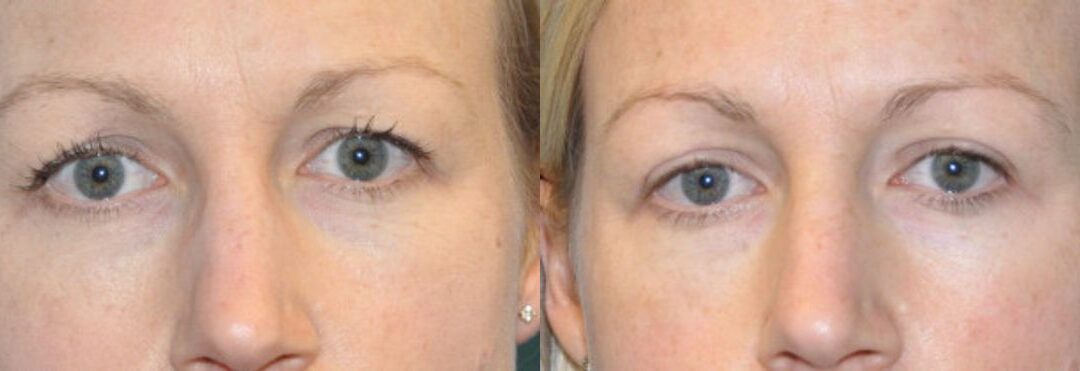 Upper Blepharoplasty (Eyelid Lift) #1