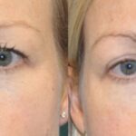 Upper Blepharoplasty (Eyelid Lift) #1 - Before and After