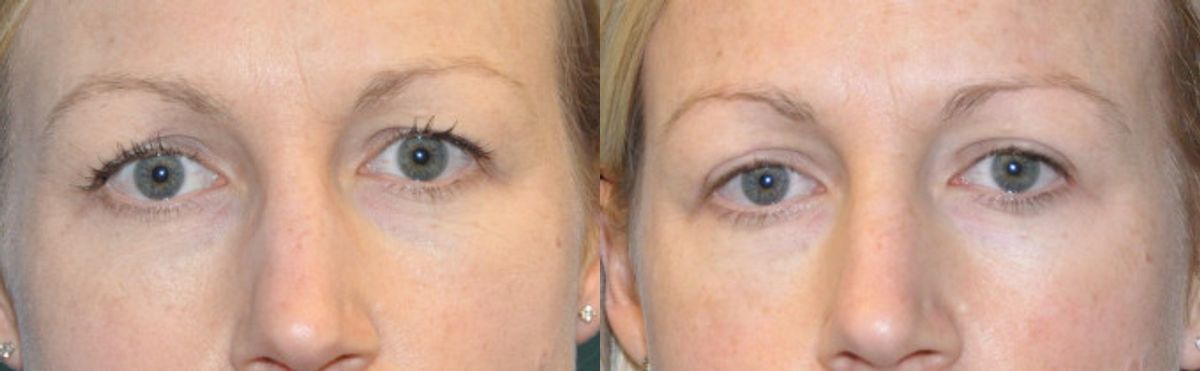 Upper Blepharoplasty (Eyelid Lift) #1 - Before and After