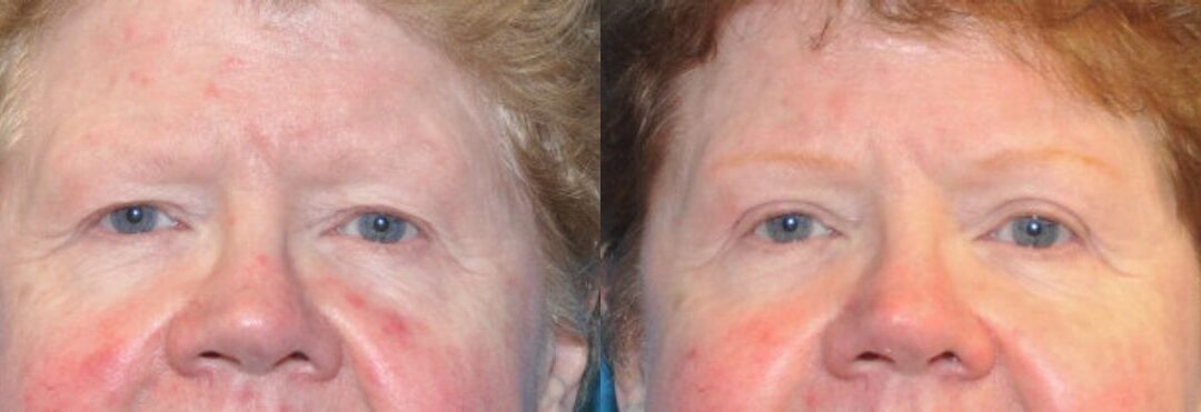 Upper Blepharoplasty (Eyelid Lift) #2