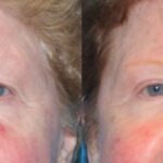 Upper Blepharoplasty (Eyelid Lift) #2 - Before and After