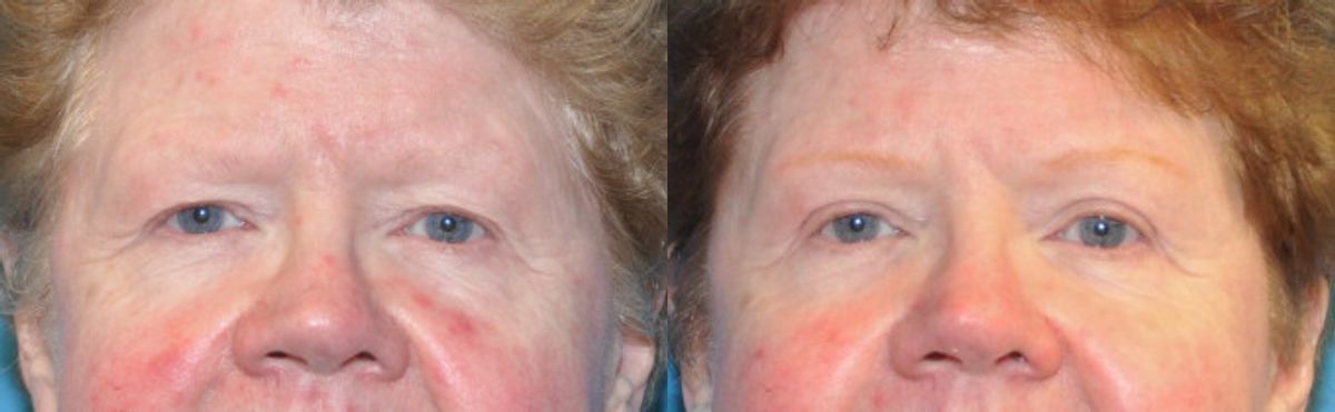 Upper Blepharoplasty (Eyelid Lift) #2 - Before and After