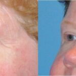 Upper Blepharoplasty (Eyelid Lift) #2 - Before and After