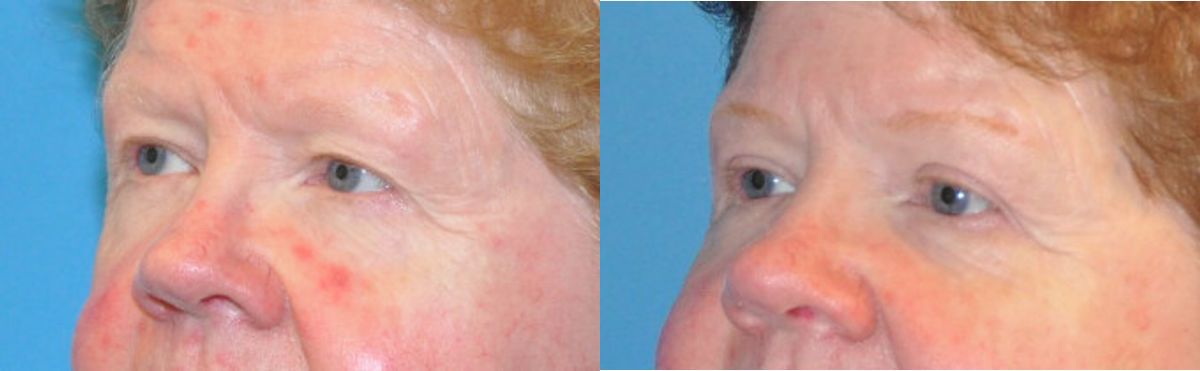 Upper Blepharoplasty (Eyelid Lift) #2 - Before and After