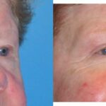 Upper Blepharoplasty (Eyelid Lift) #2 - Before and After