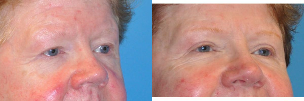 Upper Blepharoplasty (Eyelid Lift) #2 - Before and After