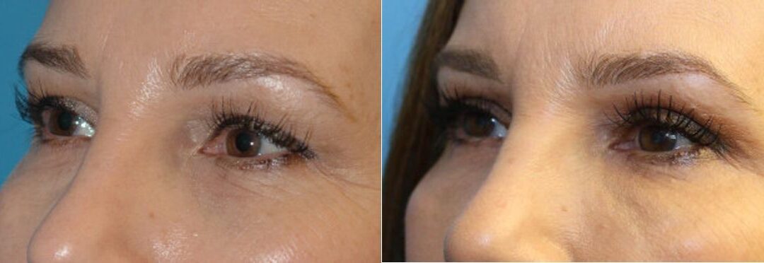 Upper Blepharoplasty (Eyelid Lift) #3