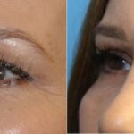Upper Blepharoplasty (Eyelid Lift) #3 - Before and After