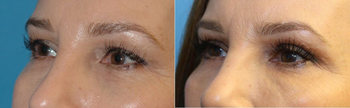 Upper Blepharoplasty (Eyelid Lift) #3 - Before and After