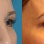 Upper Blepharoplasty (Eyelid Lift) #3 - Before and After
