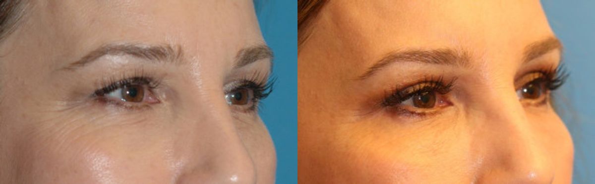 Upper Blepharoplasty (Eyelid Lift) #3 - Before and After