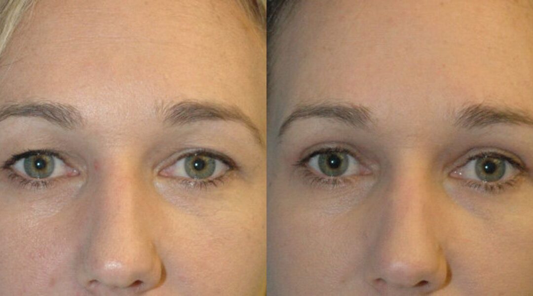 Upper Eyelid Lift (Blepharoplasty) #4