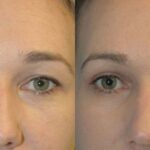 Upper Eyelid Lift (Blepharoplasty) #4 - Before and After