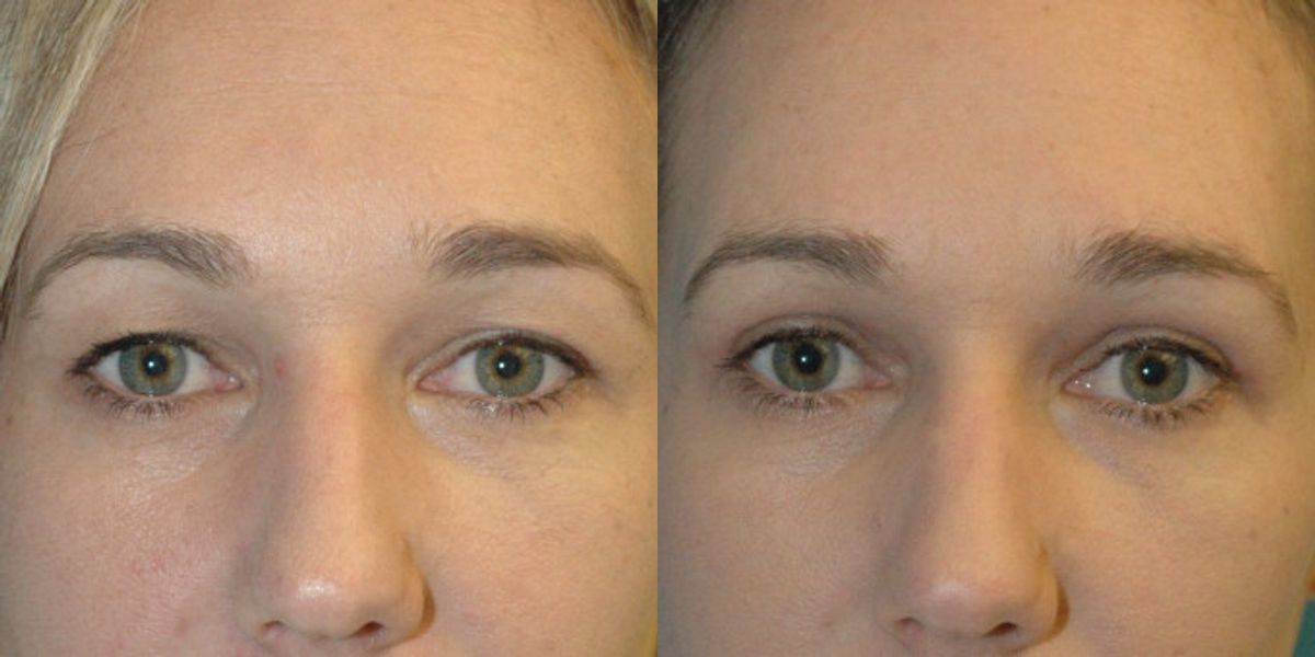 Upper Eyelid Lift (Blepharoplasty) #4 - Before and After
