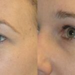 Upper Eyelid Lift (Blepharoplasty) #4 - Before and After