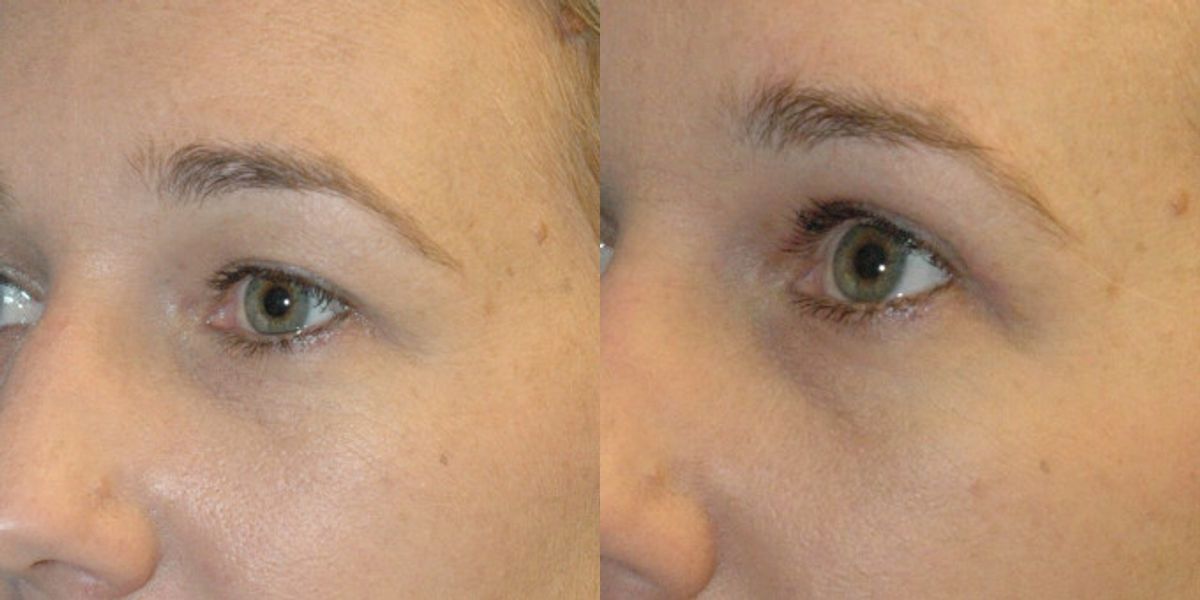 Upper Eyelid Lift (Blepharoplasty) #4 - Before and After