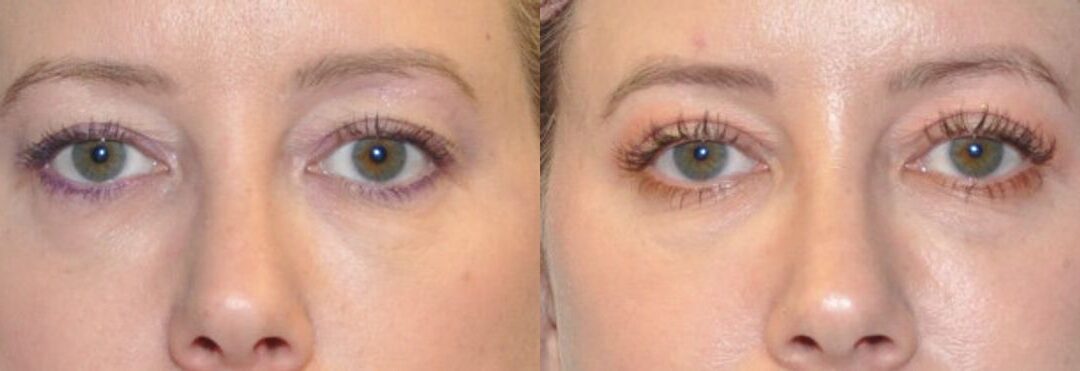 Upper Eyelid Lift (Blepharoplasty) #5